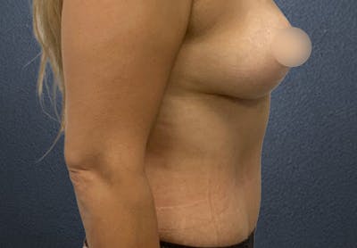 Tummy Tuck Before & After Gallery - Patient 369624 - Image 4
