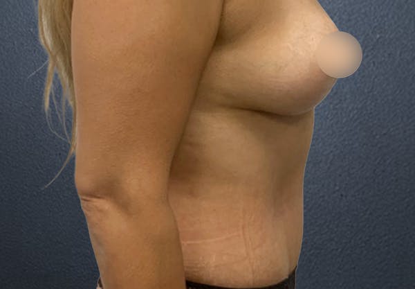 Tummy Tuck Before & After Gallery - Patient 369624 - Image 4