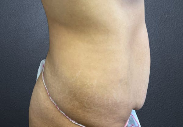 Tummy Tuck Before & After Gallery - Patient 369624 - Image 3