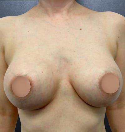Breast Augmentation Before & After Gallery - Patient 143213 - Image 2