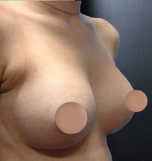 Breast Augmentation Before & After Gallery - Patient 121063 - Image 2