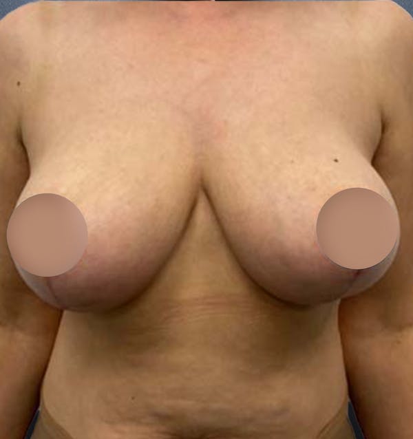 Breast Lift Before & After Gallery - Patient 357851 - Image 2
