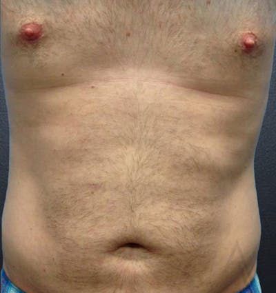 Liposuction Before & After Gallery - Patient 870832 - Image 2