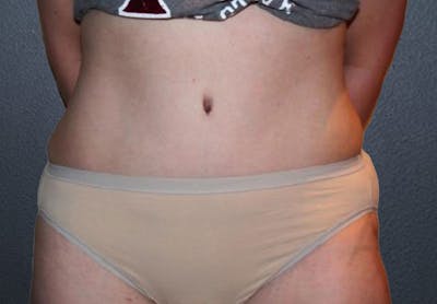 Liposuction Before & After Gallery - Patient 235383 - Image 2