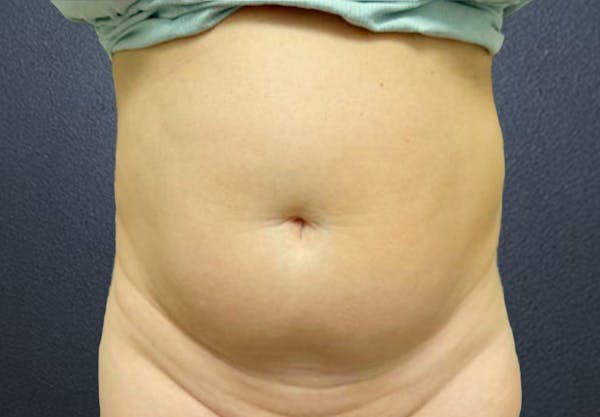 Liposuction Before & After Gallery - Patient 171393 - Image 1