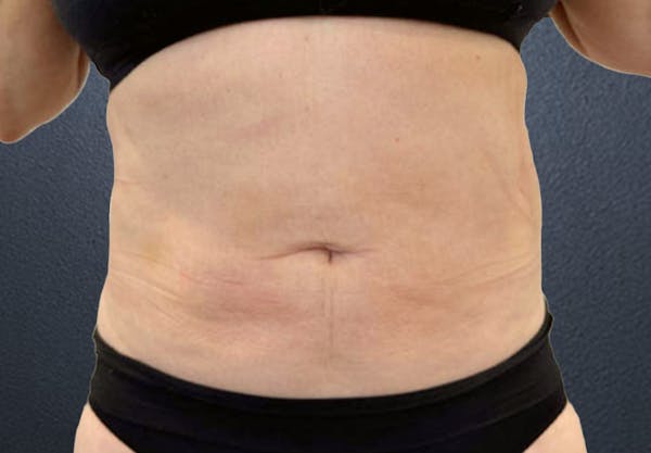 Liposuction Before & After Gallery - Patient 171393 - Image 2