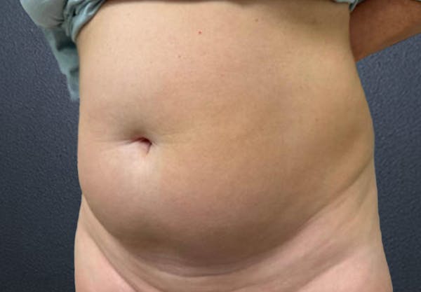 Liposuction Before & After Gallery - Patient 171393 - Image 3
