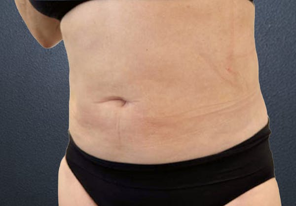 Liposuction Before & After Gallery - Patient 171393 - Image 4
