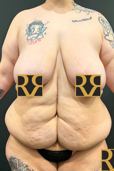 Plus Size Tummy Tuck: Day After Surgery Before & After Gallery - Patient 488454 - Image 1