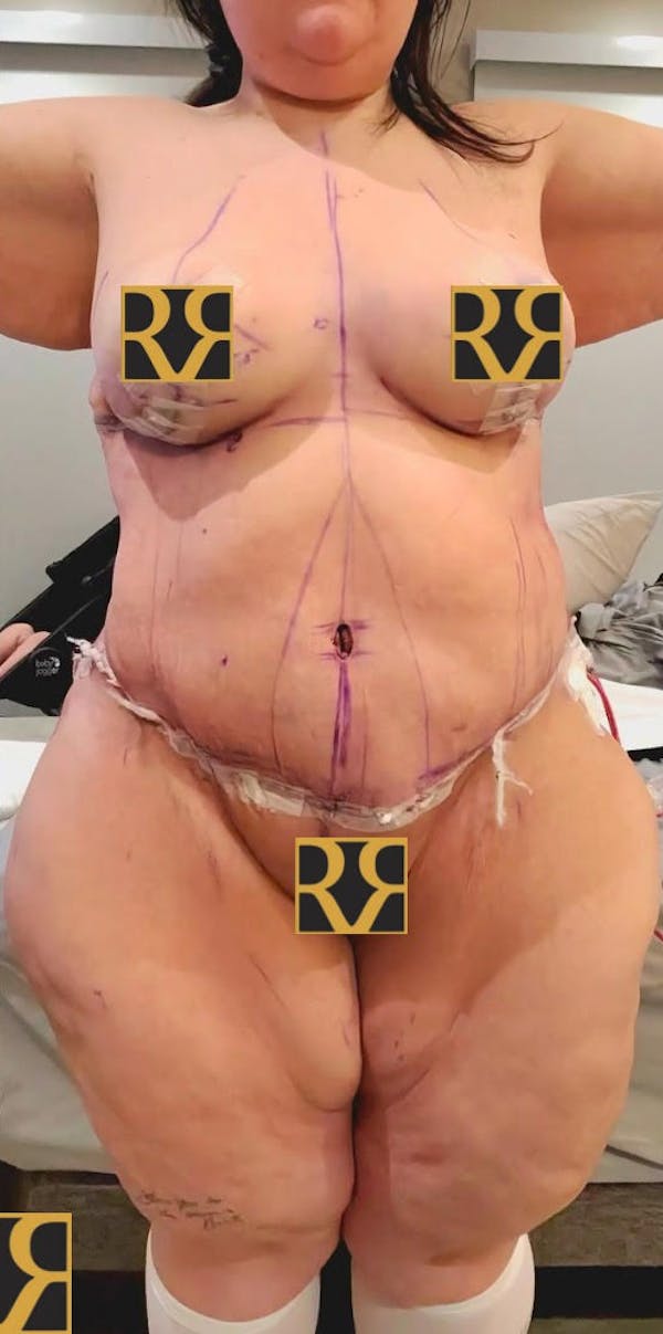 Plus Size Tummy Tuck: Day After Surgery Before & After Gallery - Patient 296294 - Image 2