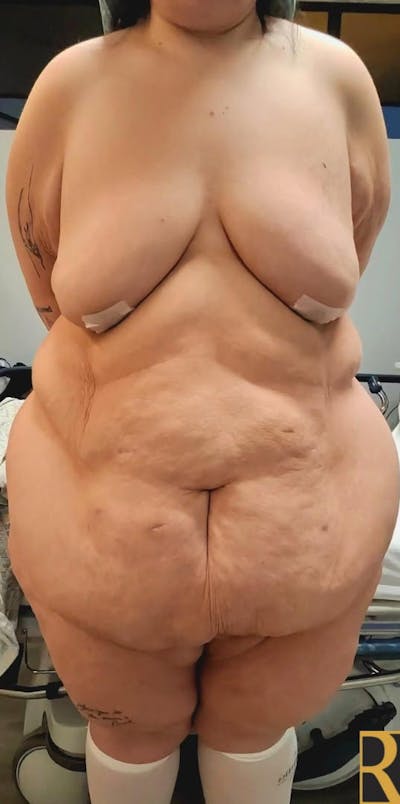 Plus Size Tummy Tuck: Day After Surgery Before & After Gallery - Patient 296294 - Image 1
