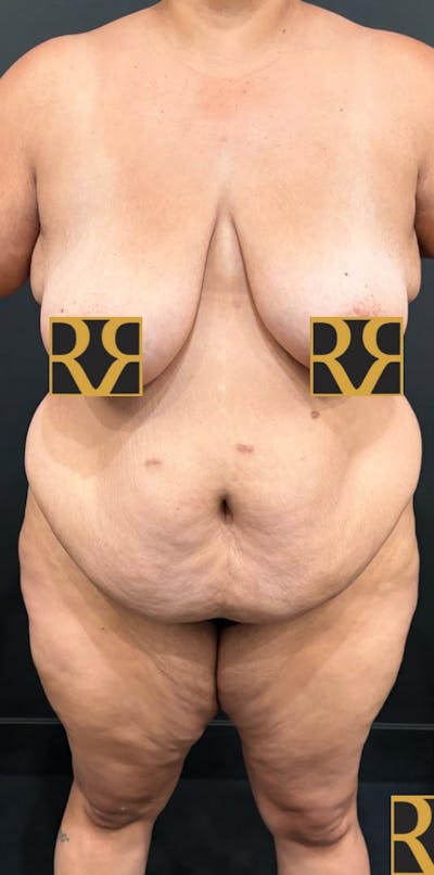 Plus Size Tummy Tuck: Week After Surgery Before & After Gallery - Patient 315490 - Image 1