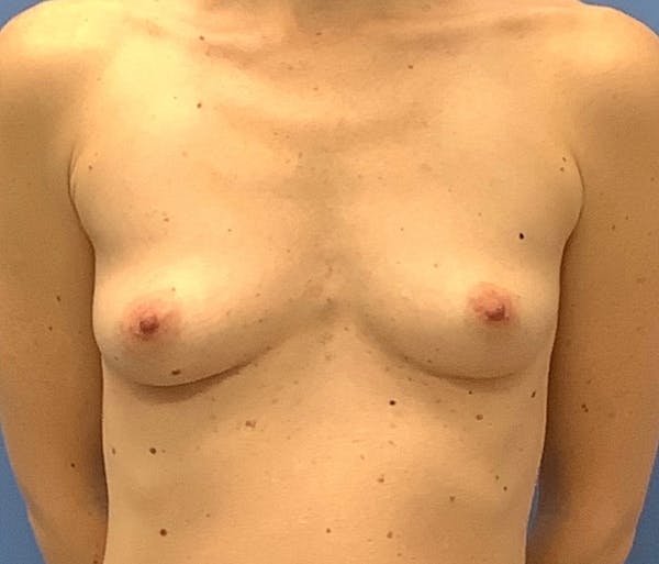 Breast Augmentation Before & After Gallery - Patient 56986231 - Image 1