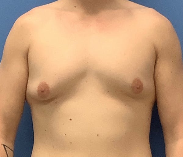 Male Breast Reduction Before & After Gallery - Patient 56993261 - Image 1