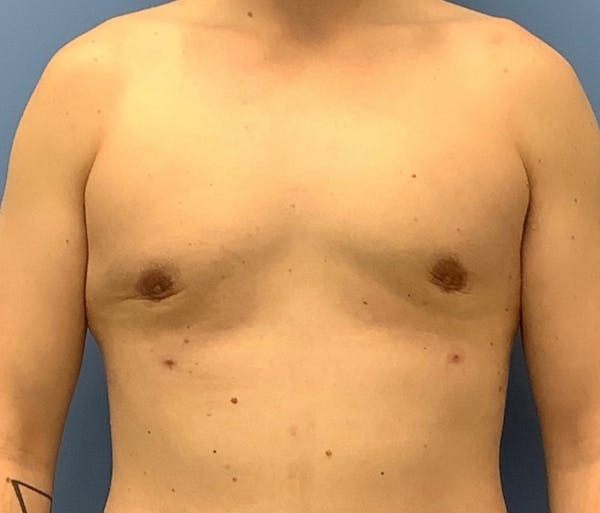 Male Breast Reduction Before & After Gallery - Patient 56993261 - Image 2