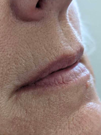 Before and After Fillers at Elevé Plastic Surgery