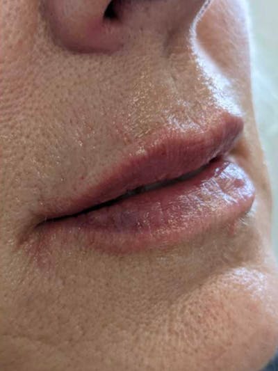 Before and After Fillers at Elevé Plastic Surgery