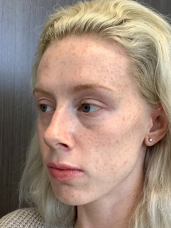 Fillers Before & After Gallery - Patient 66603805 - Image 3