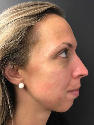 Fillers Before & After Gallery - Patient 70141517 - Image 1