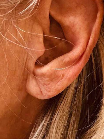 Fillers Before & After Gallery - Patient 70141518 - Image 1