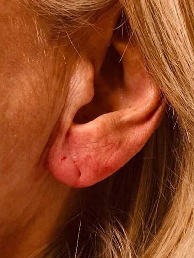 Fillers Before & After Gallery - Patient 70141518 - Image 2