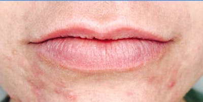 Fillers Before & After Gallery - Patient 70141519 - Image 1