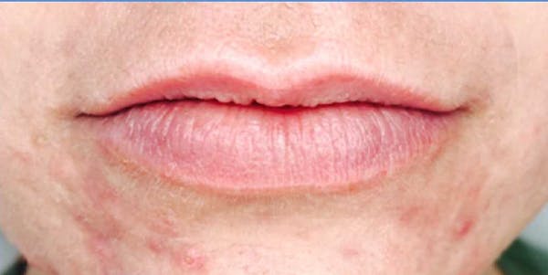 Fillers Before & After Gallery - Patient 70141519 - Image 1