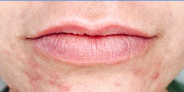 Fillers Before & After Gallery - Patient 70141519 - Image 1