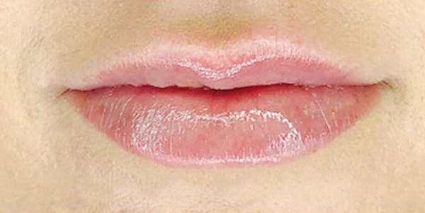 Fillers Before & After Gallery - Patient 70141519 - Image 2