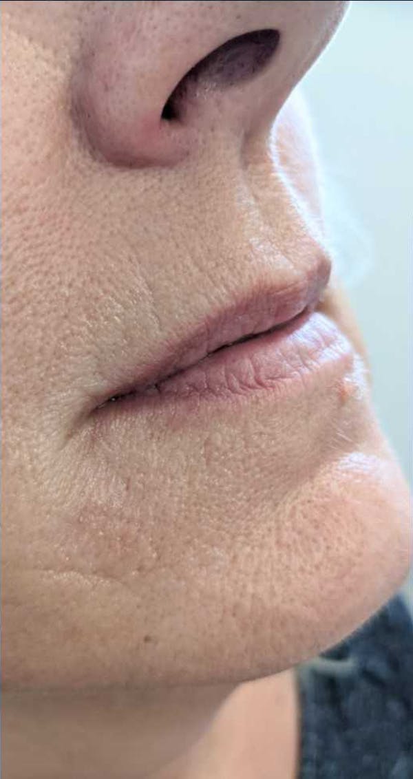 Fillers Before & After Gallery - Patient 56993359 - Image 1