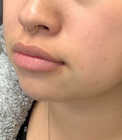Fillers Before & After Gallery - Patient 74002988 - Image 1