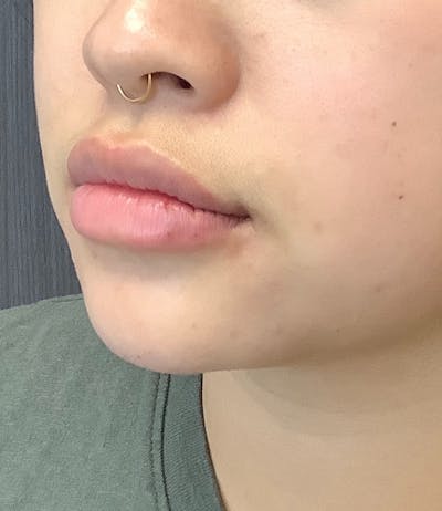 Fillers Before & After Gallery - Patient 74002988 - Image 2