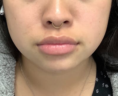 Fillers Before & After Gallery - Patient 74002989 - Image 1