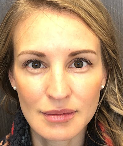 Fillers Before & After Gallery - Patient 74002990 - Image 2
