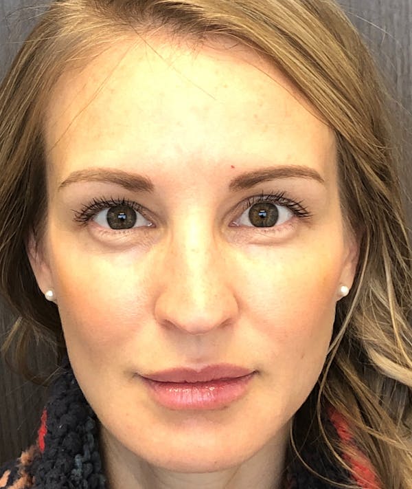 Fillers Before & After Gallery - Patient 74002990 - Image 2