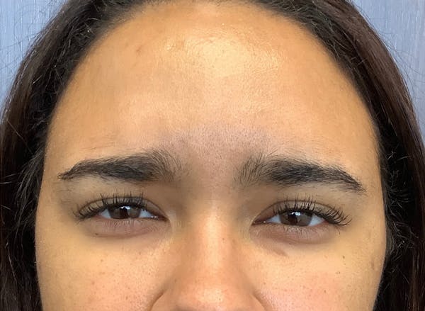 Botox Before & After Gallery - Patient 82268610 - Image 2