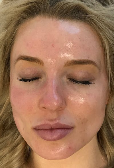 Hydrafacial  Before & After Gallery - Patient 82268637 - Image 2
