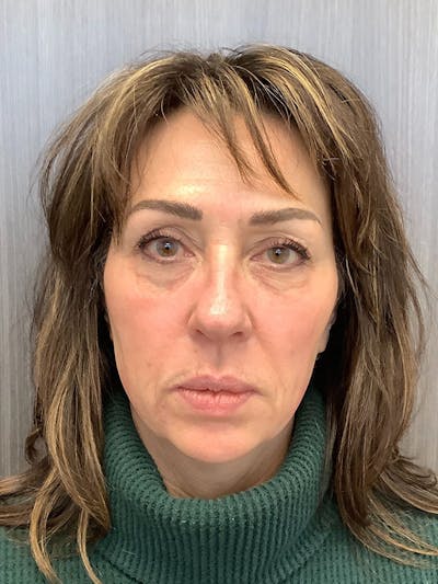 Facial Rejuvenation Before & After Gallery - Patient 87147150 - Image 2