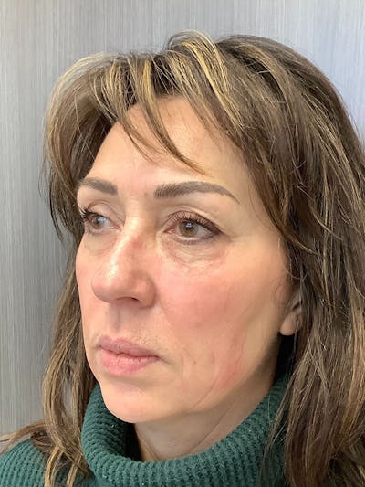 Facial Rejuvenation Before & After Gallery - Patient 87147150 - Image 6