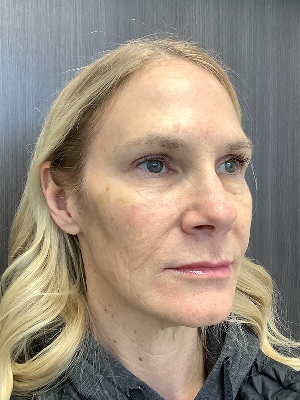 Botox Before & After Gallery - Patient 108771262 - Image 4