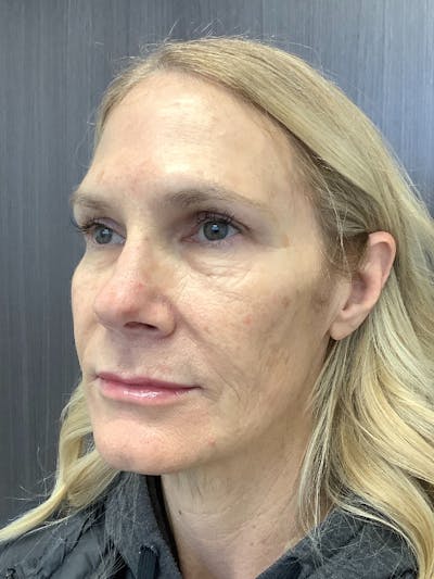 Botox Before & After Gallery - Patient 108771262 - Image 6