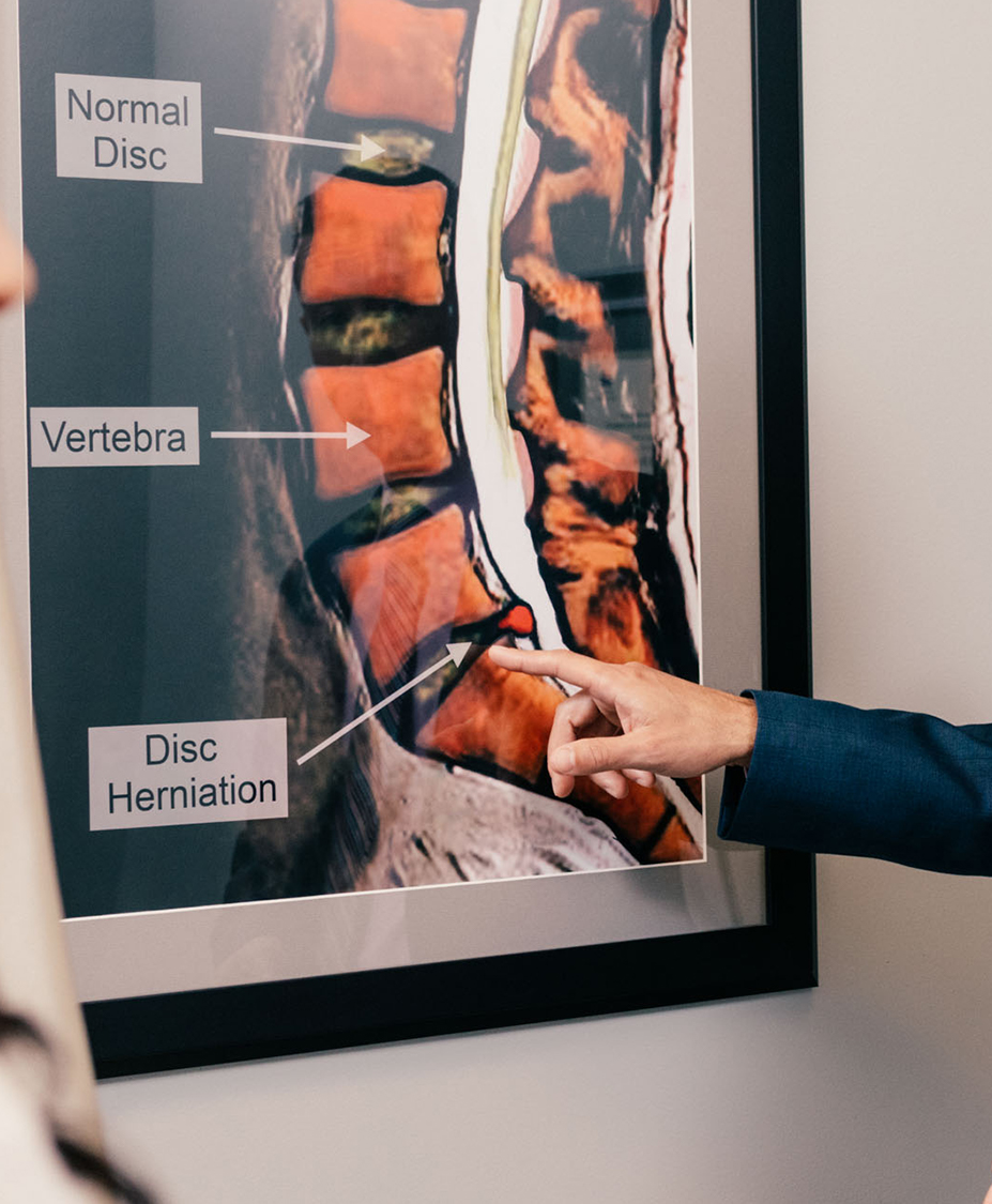 Herniated Disc Surgery NJ Lumbar Disc Herniation Dr. Rovner