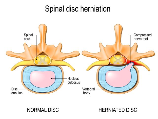 image of a spinal disc herniation