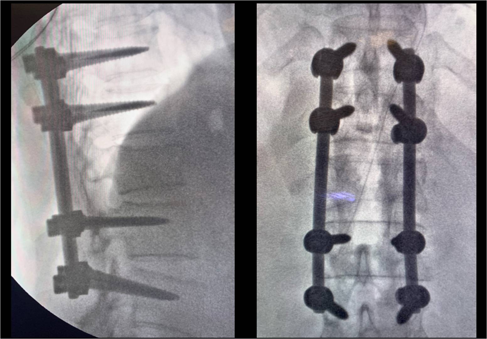 xray showing devices in the body