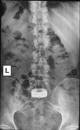 front view of an xray spine