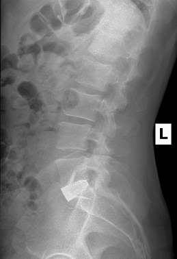 side view of an xray spine