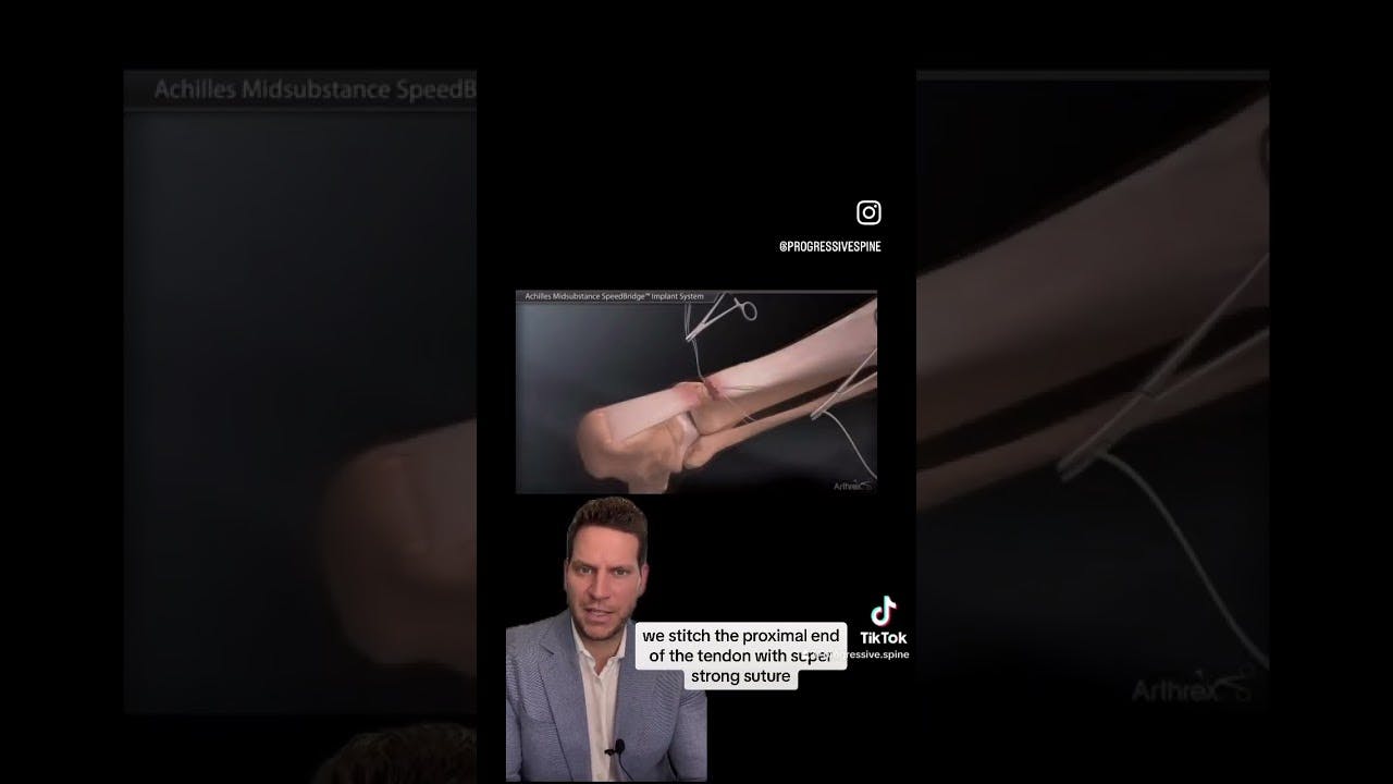 tik tok screen shot with doctor explaing a stitch in the proximal end of tendon