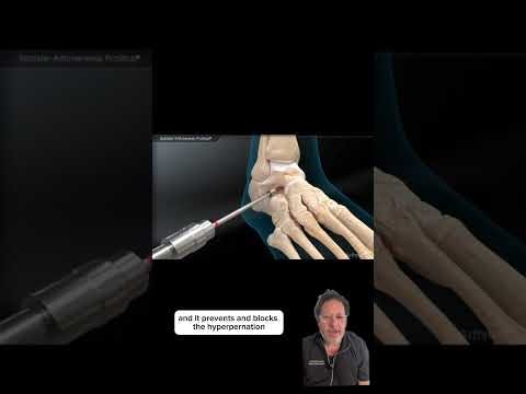 How To Fix Flat Foot- Dr. Bernstein