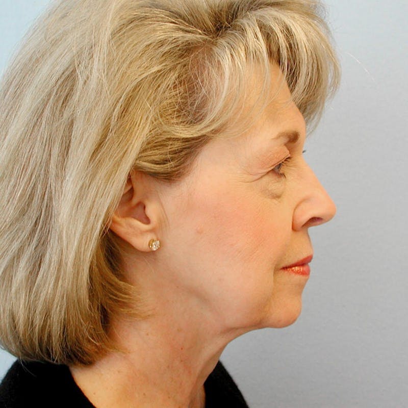 Eyelid Lift Before & After Gallery - Patient 20906461 - Image 5