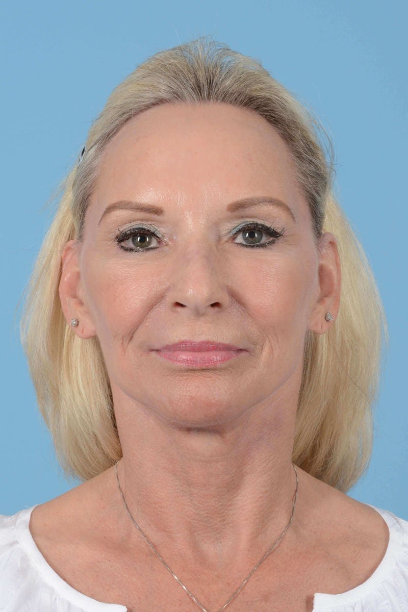 Eyelid Lift Before & After Gallery - Patient 20906517 - Image 2